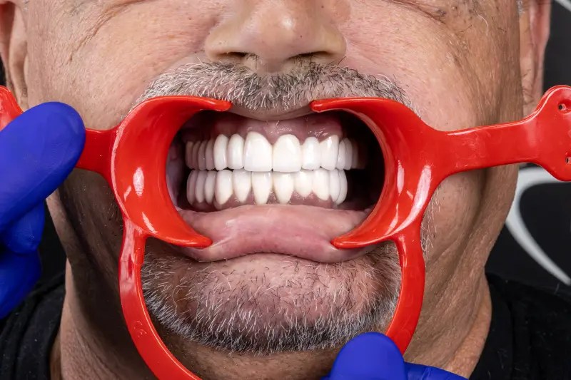 Trajno vratite osmijeh dentalnim implantatima